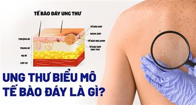 Ung thư biểu mô tế bào đáy là gì?